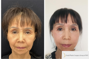 64-yo-female-underwent-Awake-Deep-plane-Facelift-Extended-Necklift-3