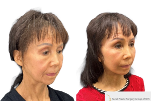64-yo-female-underwent-Awake-Deep-plane-Facelift-Extended-Necklift-4