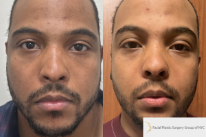 28-male-1-month-after-Buccal-fat-reduction-1