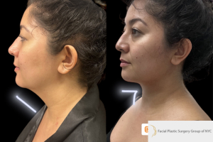 33-female-1-month-after-chin-and-neck-LIPO-and-facetite-1