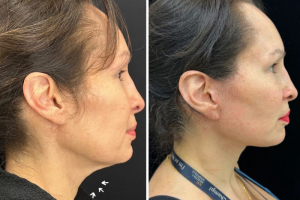 50-female-9-months-after-facelift-1-1