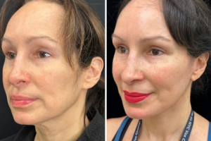 50-female-9-months-after-facelift-1-2