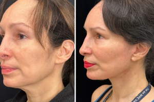 50-female-9-months-after-facelift-1-3