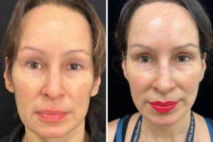50-female-9-months-after-facelift-1-4