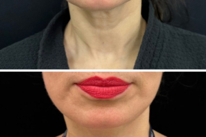 50-female-9-months-after-facelift-1-5