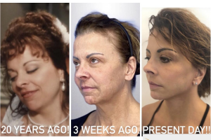 58-y.o-female-who-underwent-Deep-Plane-Facelift-Extended-Deep-plane-Neck-Lift-and-CO2-laser-to-face-1