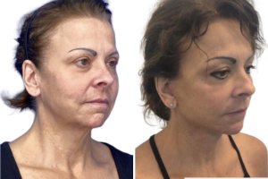 58-y.o-female-who-underwent-Deep-Plane-Facelift-Extended-Deep-plane-Neck-Lift-and-CO2-laser-to-face-2