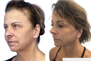 58-y.o-female-who-underwent-Deep-Plane-Facelift-Extended-Deep-plane-Neck-Lift-and-CO2-laser-to-face-3