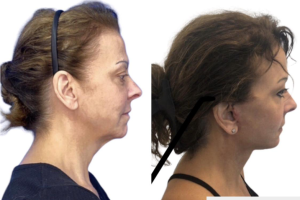 58-y.o-female-who-underwent-Deep-Plane-Facelift-Extended-Deep-plane-Neck-Lift-and-CO2-laser-to-face-4