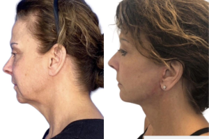 58-y.o-female-who-underwent-Deep-Plane-Facelift-Extended-Deep-plane-Neck-Lift-and-CO2-laser-to-face-5