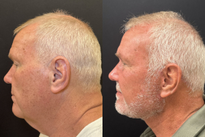 65-male-3-months-after-deep-plane-facelift-1-1