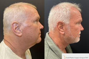 65-male-3-months-after-deep-plane-facelift-1-2