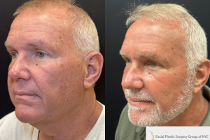 65-male-3-months-after-deep-plane-facelift-1-3