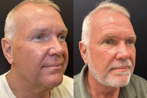 65-male-3-months-after-deep-plane-facelift-1-4