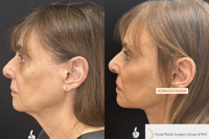 75-female-3-months-after-facelift-and-facial-fat-transfer-1-1