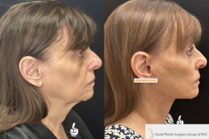 75-female-3-months-after-facelift-and-facial-fat-transfer-1-2