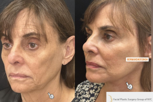 75-female-3-months-after-facelift-and-facial-fat-transfer-1-4
