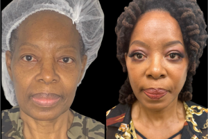 66-y.o-female-Deep-Plane-Facelift-Necklift-and-Upper-Blepharoplasty-1-1