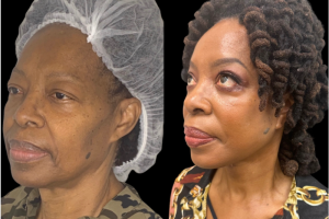 66-y.o-female-Deep-Plane-Facelift-Necklift-and-Upper-Blepharoplasty-1-2