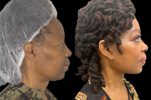 66-y.o-female-Deep-Plane-Facelift-Necklift-and-Upper-Blepharoplasty-1-3