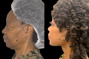 66-y.o-female-Deep-Plane-Facelift-Necklift-and-Upper-Blepharoplasty-1-4