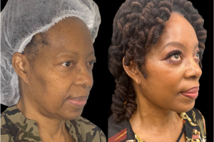 66-y.o-female-Deep-Plane-Facelift-Necklift-and-Upper-Blepharoplasty-1-5