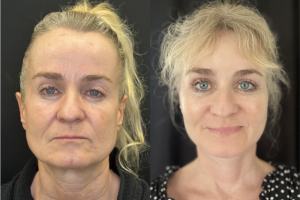 60-y.o-female-Awake-Deep-Plane-Facelift-Necklift-Upper-Blepharoplasty-and-Facial-Fat-Transfer-1-1