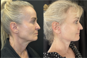 60-y.o-female-Awake-Deep-Plane-Facelift-Necklift-Upper-Blepharoplasty-and-Facial-Fat-Transfer-1-2