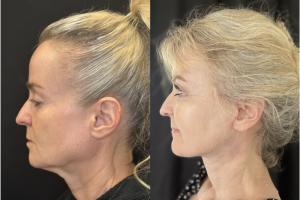 60-y.o-female-Awake-Deep-Plane-Facelift-Necklift-Upper-Blepharoplasty-and-Facial-Fat-Transfer-1-3