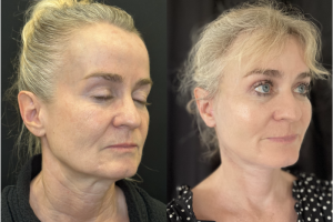 60-y.o-female-Awake-Deep-Plane-Facelift-Necklift-Upper-Blepharoplasty-and-Facial-Fat-Transfer-1-4