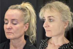 60-y.o-female-Awake-Deep-Plane-Facelift-Necklift-Upper-Blepharoplasty-and-Facial-Fat-Transfer-1-5