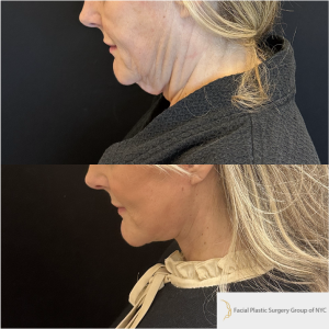 52-y.o-female-Awake-Deep-Plane-Facelift-and-Necklift-1-1