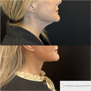52-y.o-female-Awake-Deep-Plane-Facelift-and-Necklift-1-2