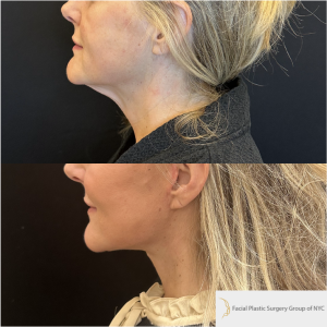 52-y.o-female-Awake-Deep-Plane-Facelift-and-Necklift-1-3