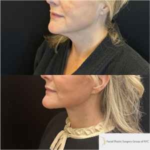 52-y.o-female-Awake-Deep-Plane-Facelift-and-Necklift-1-4