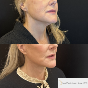 52-y.o-female-Awake-Deep-Plane-Facelift-and-Necklift-1-5