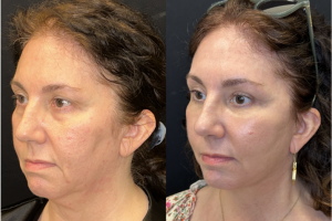 57-y.o-female-Awake-Deep-Plane-Facelift-Necklift-Upper-Lower-Blepharoplasty-Facial-Fat-Transfer-and-CO2-laser-to-face-1-1