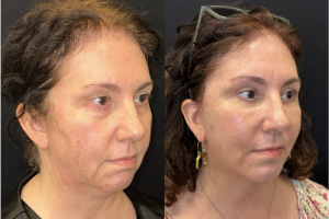 57-y.o-female-Awake-Deep-Plane-Facelift-Necklift-Upper-Lower-Blepharoplasty-Facial-Fat-Transfer-and-CO2-laser-to-face-1-2