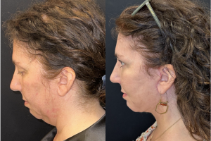 57-y.o-female-Awake-Deep-Plane-Facelift-Necklift-Upper-Lower-Blepharoplasty-Facial-Fat-Transfer-and-CO2-laser-to-face-1-3