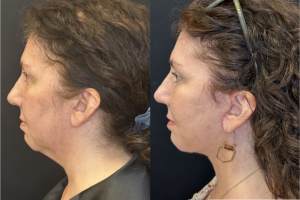57-y.o-female-Awake-Deep-Plane-Facelift-Necklift-Upper-Lower-Blepharoplasty-Facial-Fat-Transfer-and-CO2-laser-to-face-1-4