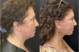 57-y.o-female-Awake-Deep-Plane-Facelift-Necklift-Upper-Lower-Blepharoplasty-Facial-Fat-Transfer-and-CO2-laser-to-face-1-5