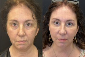 57-y.o-female-Awake-Deep-Plane-Facelift-Necklift-Upper-Lower-Blepharoplasty-Facial-Fat-Transfer-and-CO2-laser-to-face-1-6