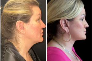 47-y.o-female-Awake-Deep-Plane-Facelift-and-Necklift-1-1