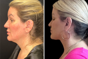 47-y.o-female-Awake-Deep-Plane-Facelift-and-Necklift-1-2