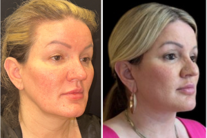 47-y.o-female-Awake-Deep-Plane-Facelift-and-Necklift-1-3