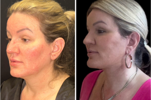 47-y.o-female-Awake-Deep-Plane-Facelift-and-Necklift-1-4