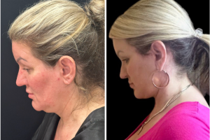 47-y.o-female-Awake-Deep-Plane-Facelift-and-Necklift-1-5