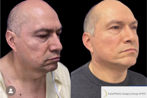54-y.o-male-who-underwent-Deep-Plane-Facelift-and-Extended-Deep-plane-Neck-Lift-1