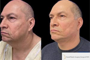54-y.o-male-who-underwent-Deep-Plane-Facelift-and-Extended-Deep-plane-Neck-Lift-2