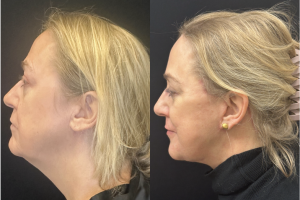 56-y.o-female-Deep-Plane-Facelift-Necklift-and-Lower-Blepharoplasty-1-1